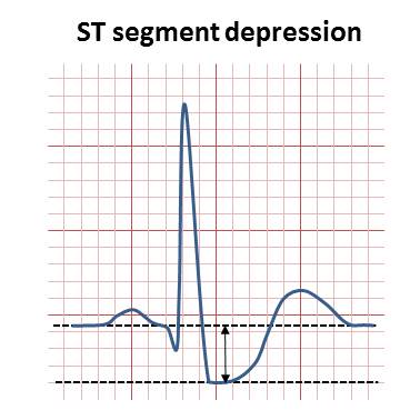 NSTEMI — sous-décalage du segment ST