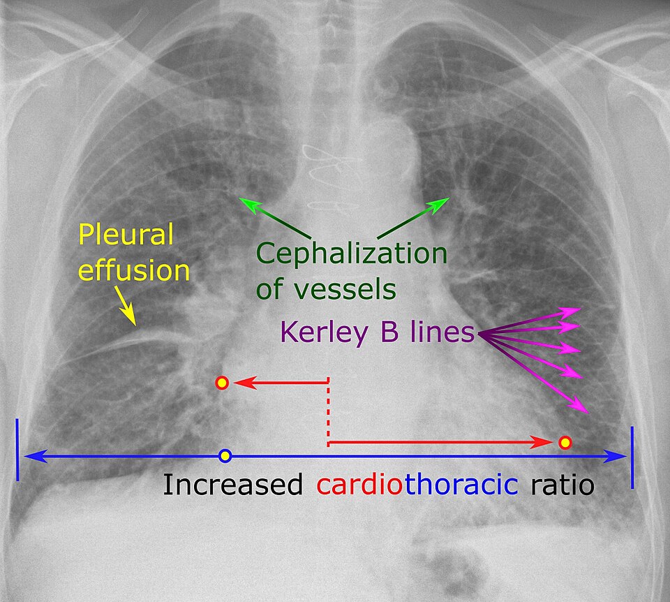 Œdème aigu du poumon (radio thorax)