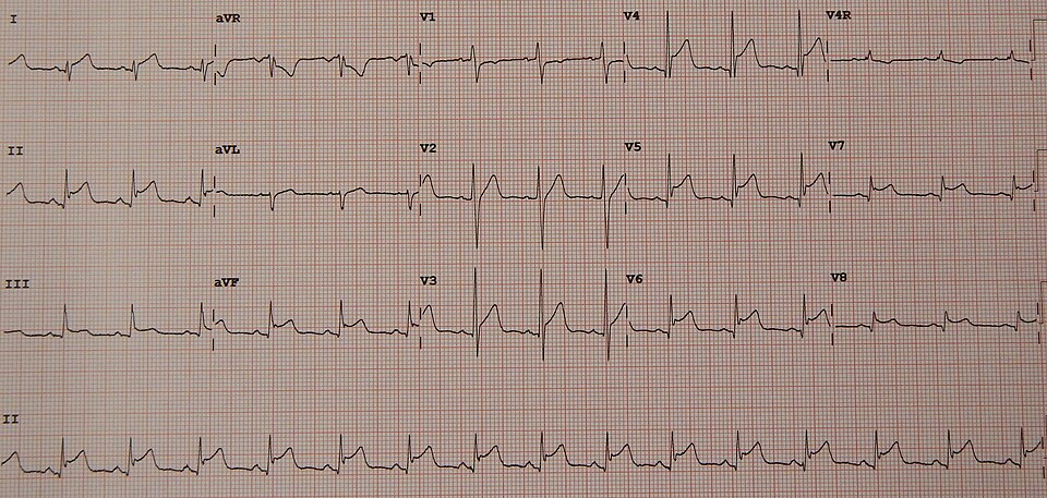 Péricardite aiguë (ECG)