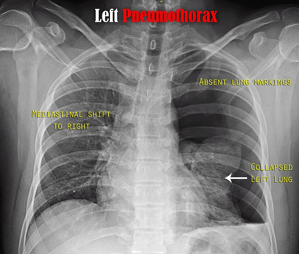 Pneumothorax (diagnostic différentiel)