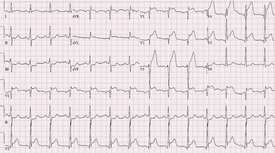 STEMI — sus-décalage du segment ST