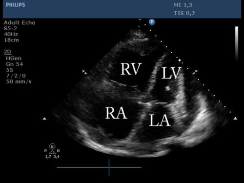 Tamponnade cardiaque