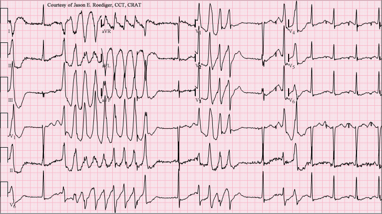 Torsades de pointes