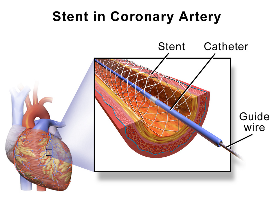 Schéma d'un stent dans une artère