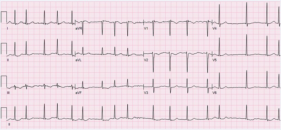 ECG montrant une fibrillation auriculaire