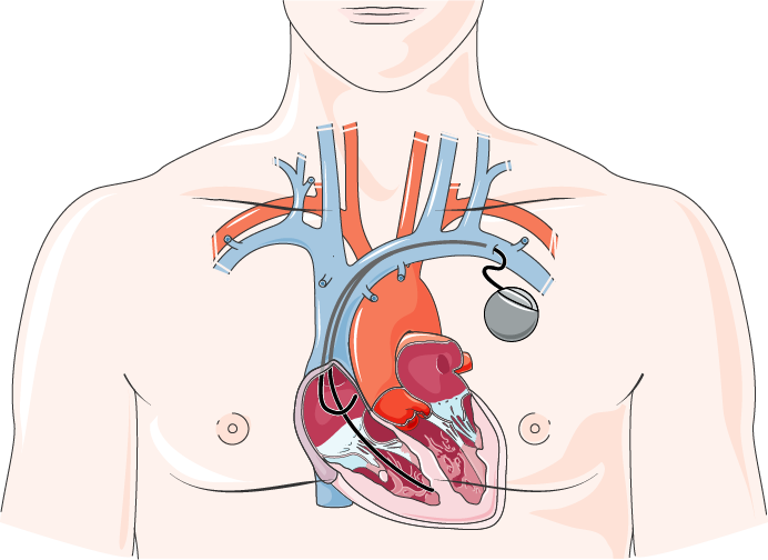 Schéma d'un pacemaker