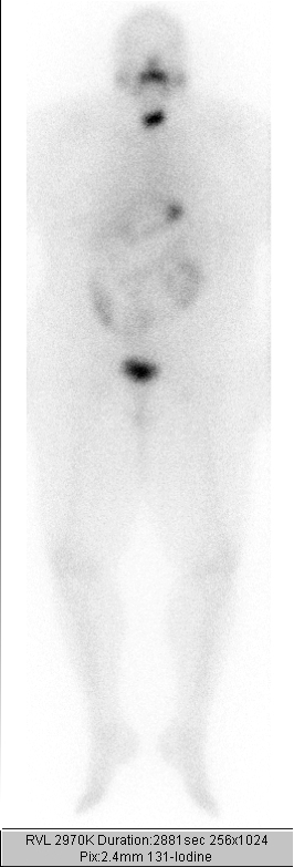 Scintigraphie thyroïdienne