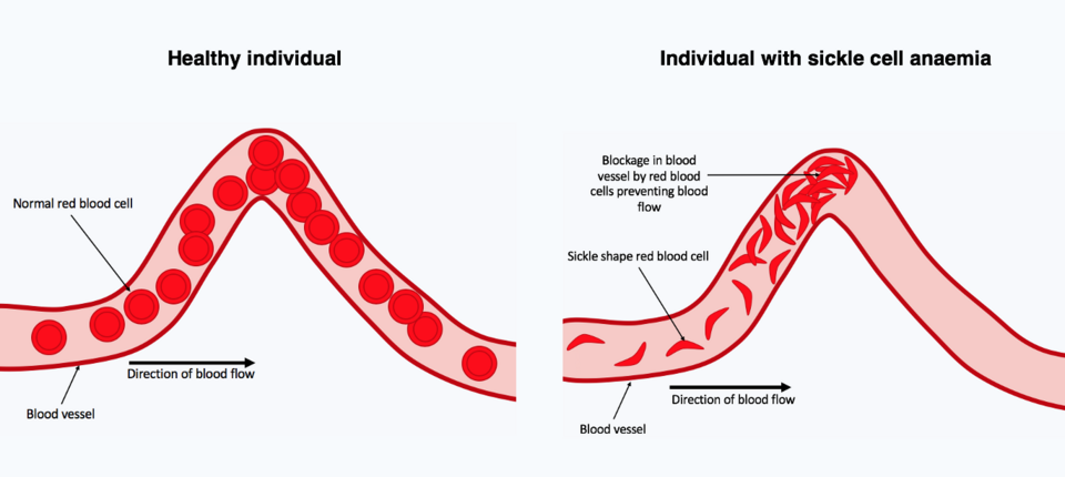 Globule rouge normal vs en faucille