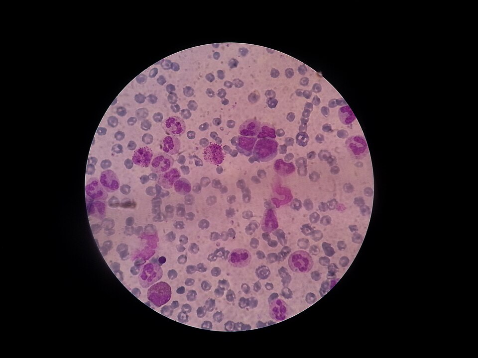 Cellules blastiques au microscope