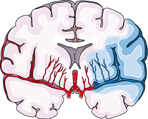 Schéma d'une thrombectomie