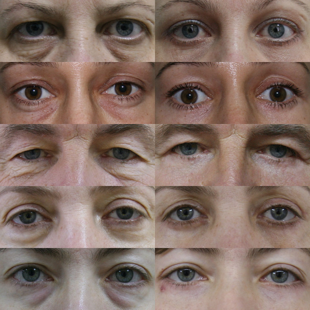 Blépharoplastie — résultat