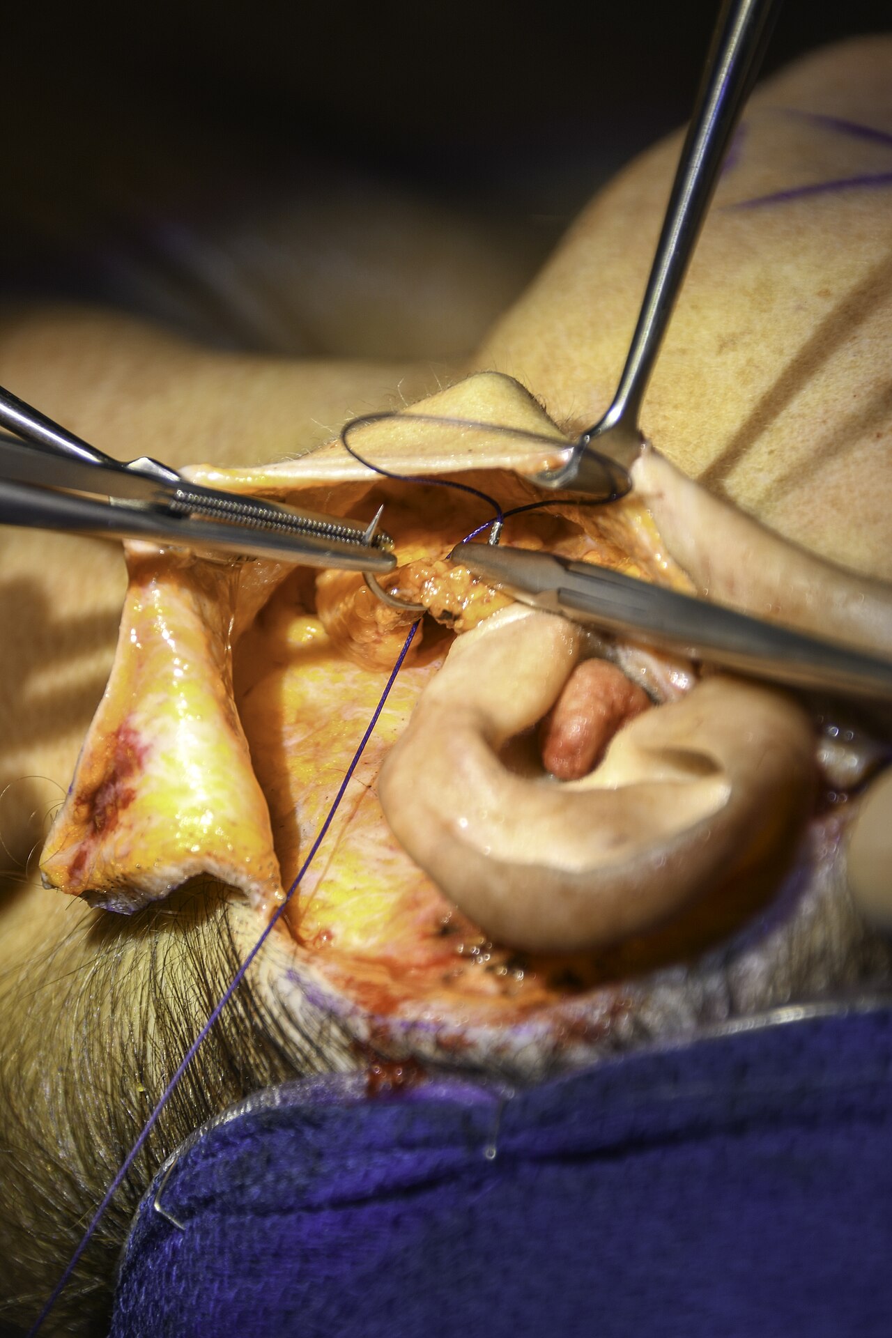 Fixation du SMAS lors d'un lifting