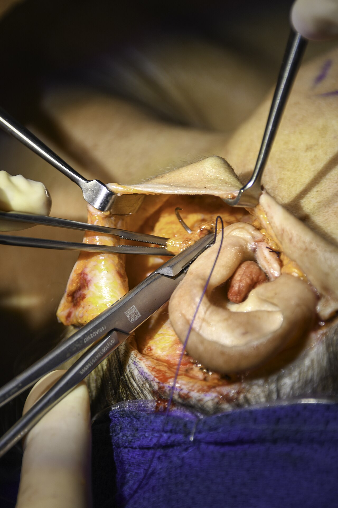 Dissection cervicale lors d'un lifting