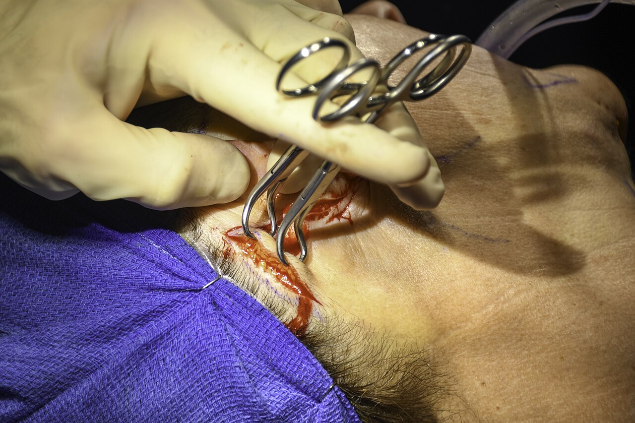 Dissection du SMAS