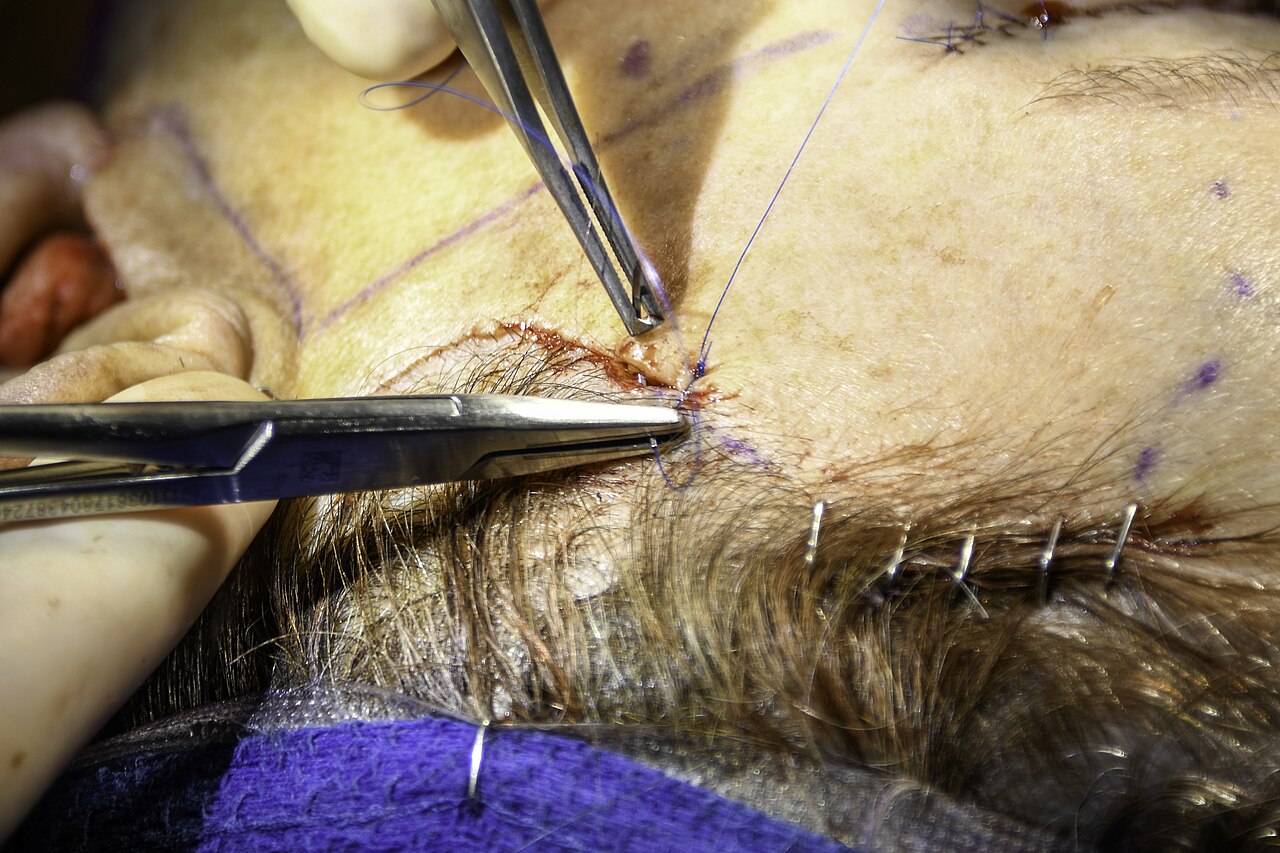 Fermeture soigneuse d'une incision