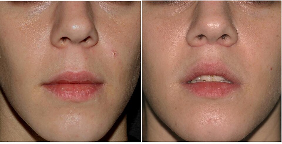 Lip lift avant et après : lèvre supérieure plus visible et pulpeuse