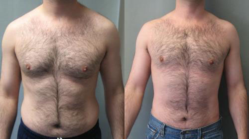 Technique de lipoaspiration