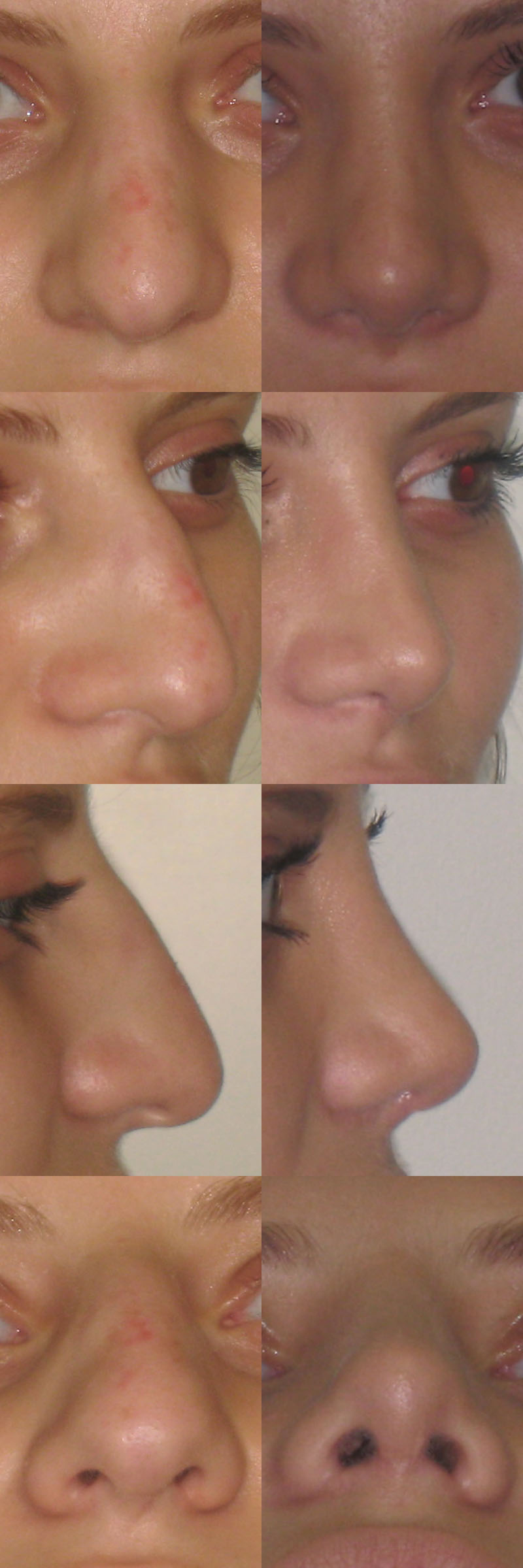 Rhinoplastie avant et après sous différents angles