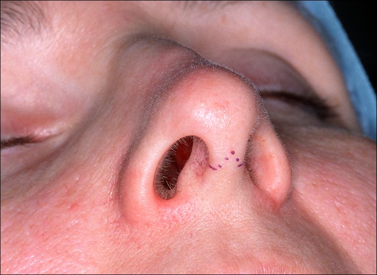 Incision columellaire pour rhinoplastie ouverte
