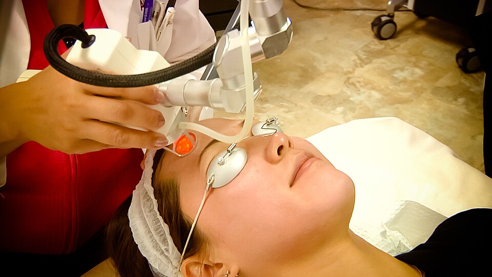 Traitement laser fractionné du visage