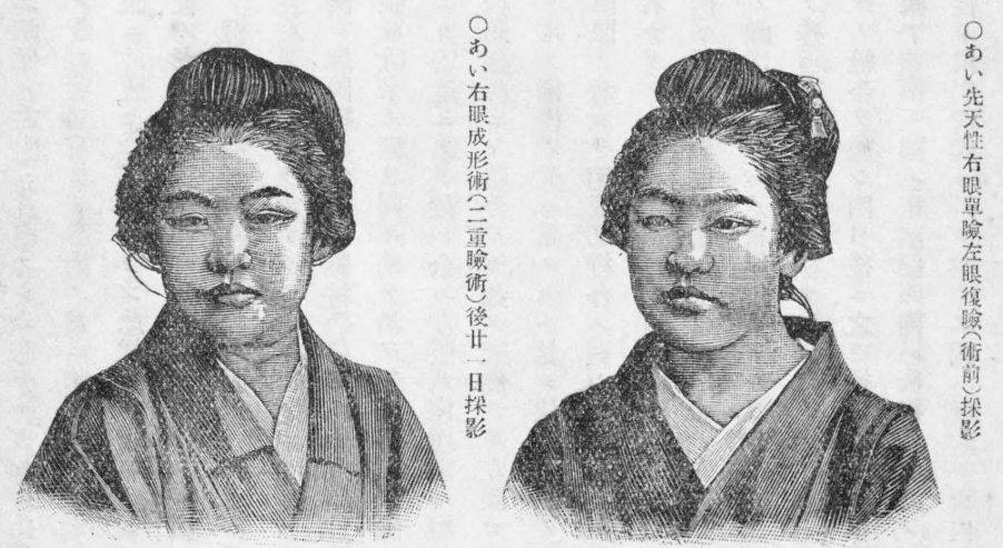 Histoire de la chirurgie de la paupière