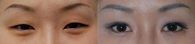 Blépharoplastie asiatique — avant/après