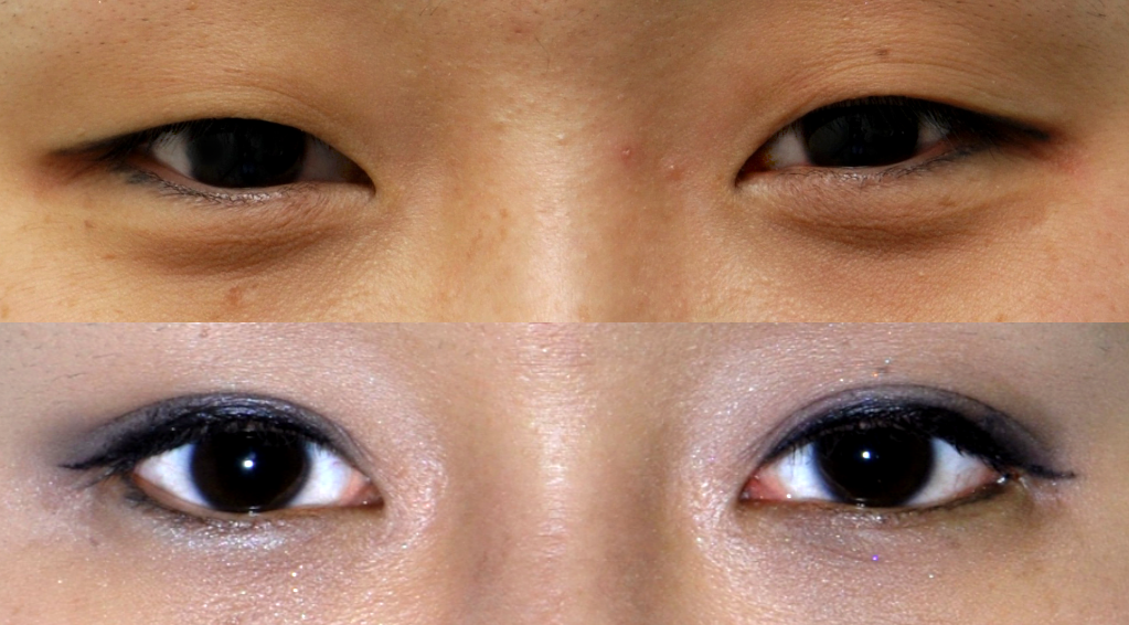 Résultat de blépharoplastie coréenne