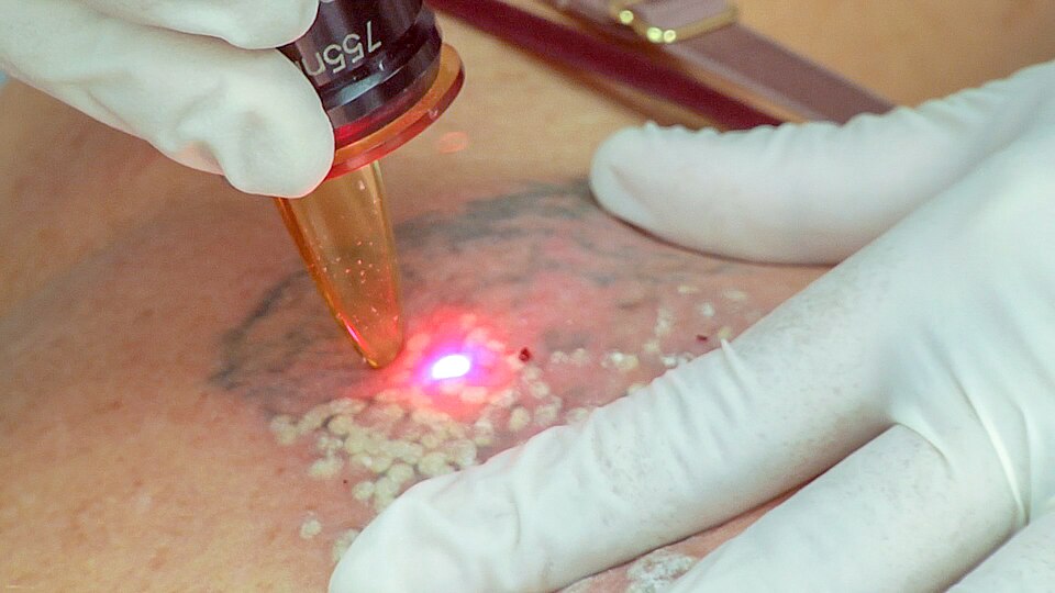 Séance de détatouage au laser Q-switched — vue rapprochée