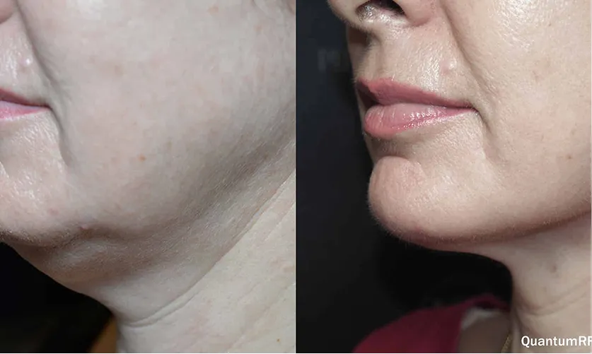 Technologies dermatologiques avancées — le Q-switched parmi les traitements pigmentaires