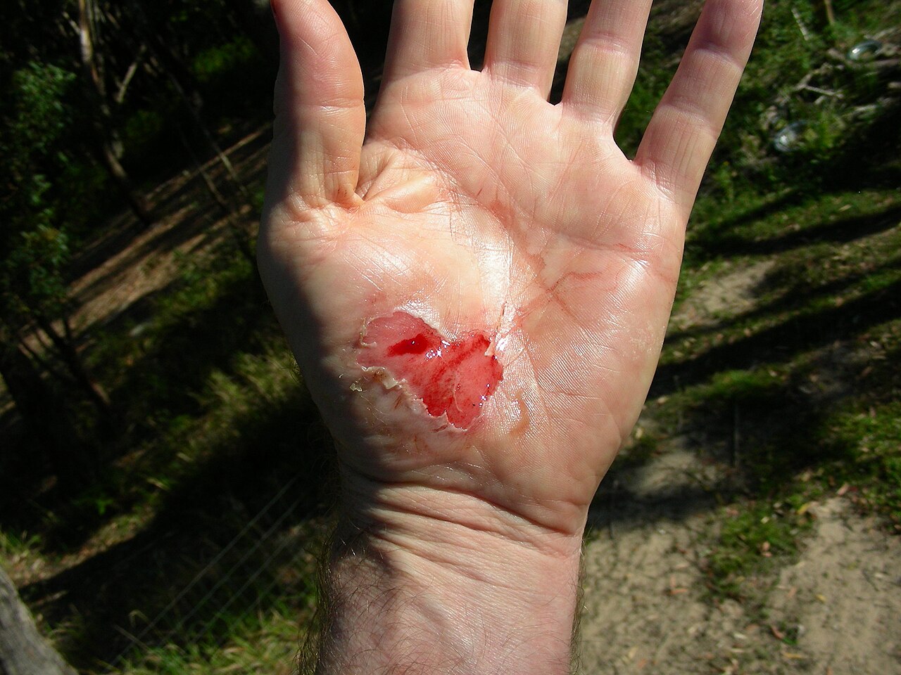 Abrasion cutanee — principe de la dermabrasion