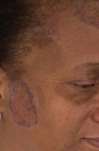 Peau avant traitement par peeling