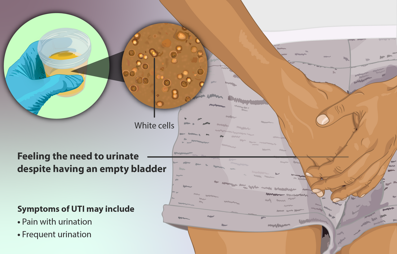 Symptômes d'infection urinaire