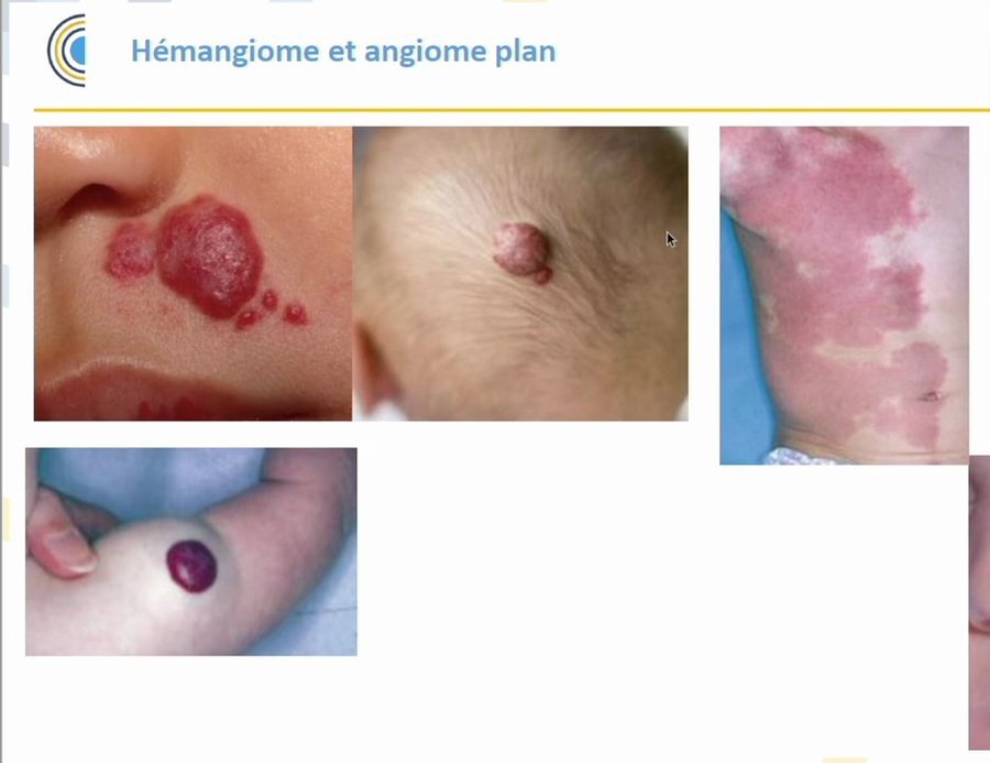 Hémangiomes infantiles : lésions en relief du visage, du cuir chevelu et du membre