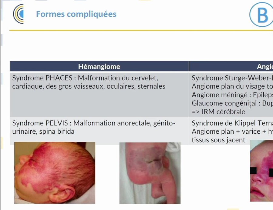 Hémangiome du cuir chevelu (syndrome PHACES) et angiome plan du visage avec yeux masqués (syndrome de Sturge-Weber)