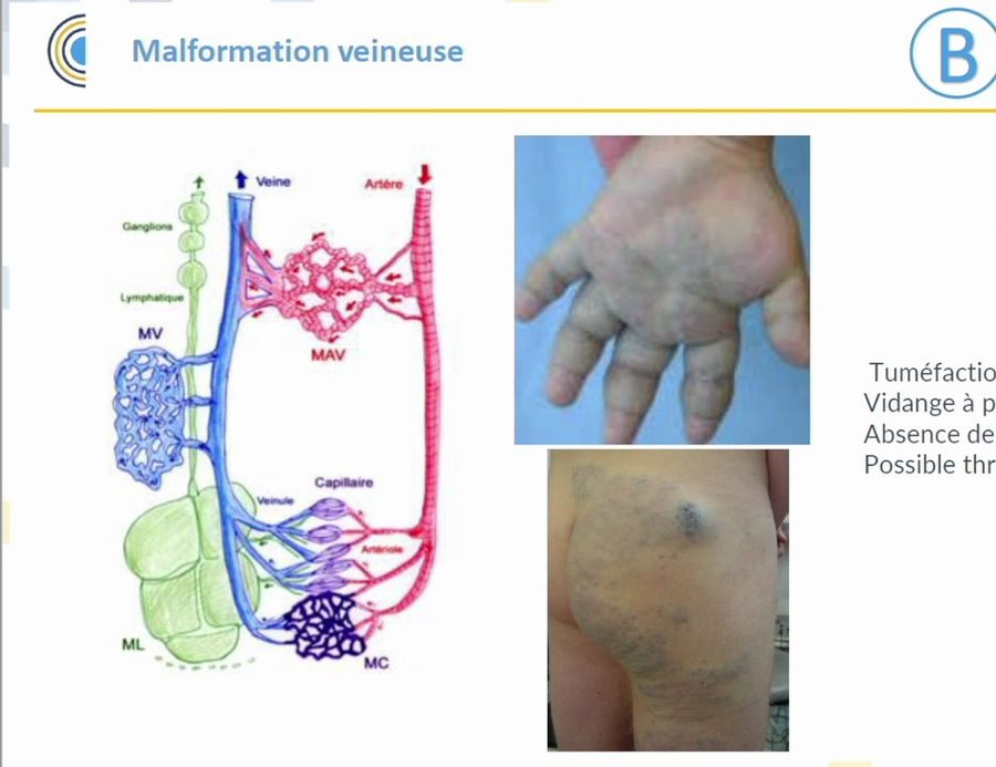 Malformation veineuse de la main et de la cuisse