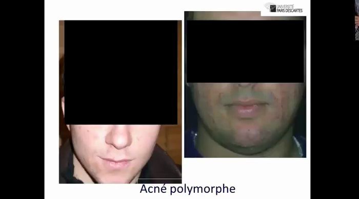 Acné polymorphe du visage (visages masqués)