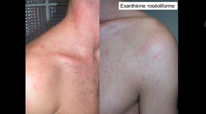 Exanthème roséoliforme du cou et de l'épaule