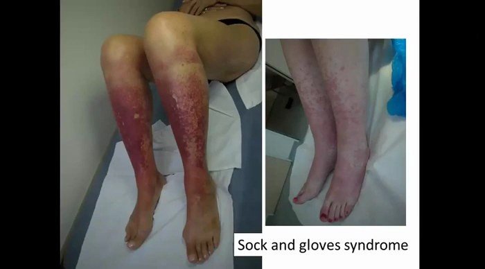 Éruption pétéchiale et purpurique en gants et chaussettes des membres inférieurs