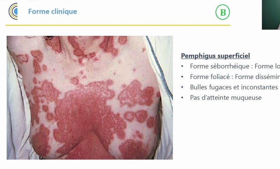 Pemphigus superficiel : érosions post-bulleuses diffuses du thorax