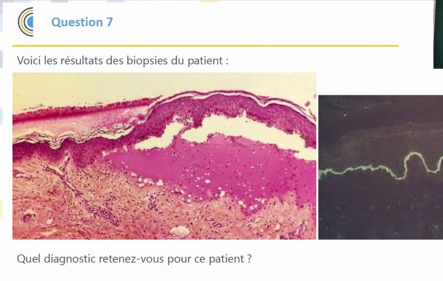 Biopsie cutanée : bulle sous-épidermique et immunofluorescence directe linéaire