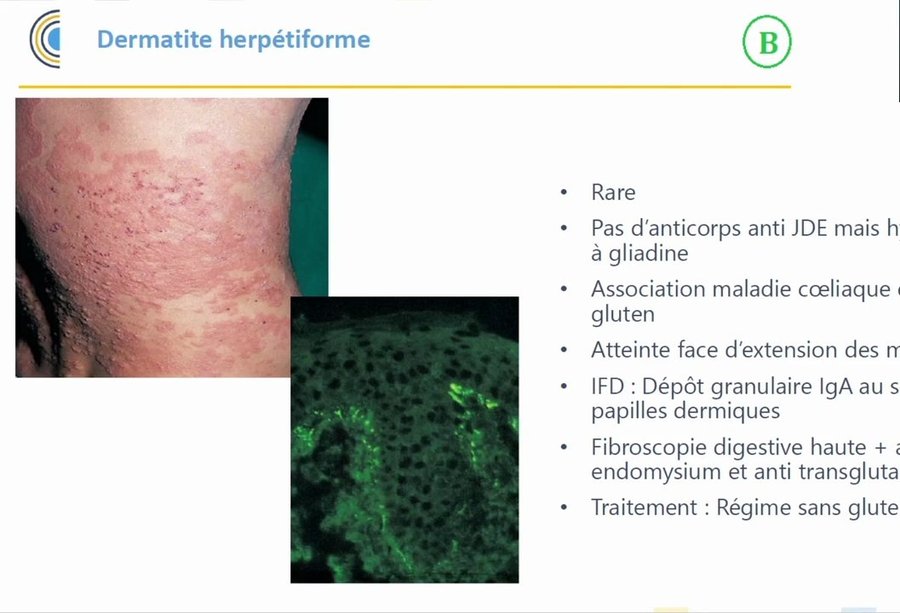 Lésions papulo-vésiculeuses excoriées du coude et immunofluorescence granulaire IgA