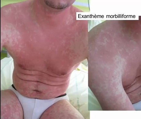 Exanthèmes et Érythrodermies