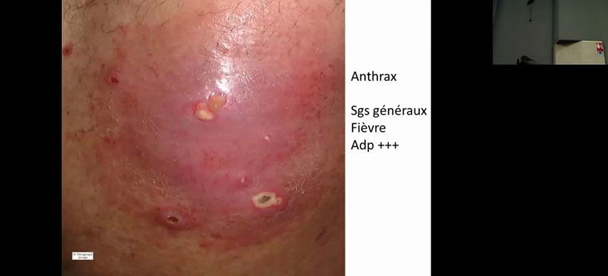 Anthrax : confluence de plusieurs furoncles avec pustules multiples