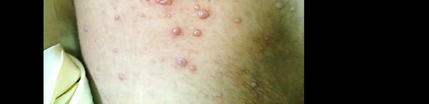 Vésicules de varicelle en gouttes de rosée sur base érythémateuse
