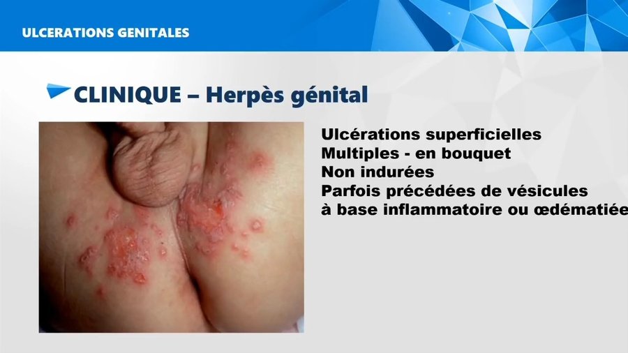 Ulcérations génitales superficielles multiples « en bouquet »