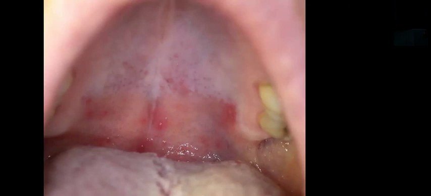 Érosions et érythème de la muqueuse buccale évocateurs de gingivostomatite herpétique
