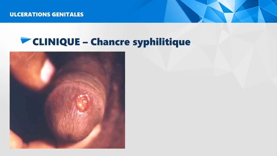 Chancre syphilitique : ulcération propre, indurée et indolore du gland