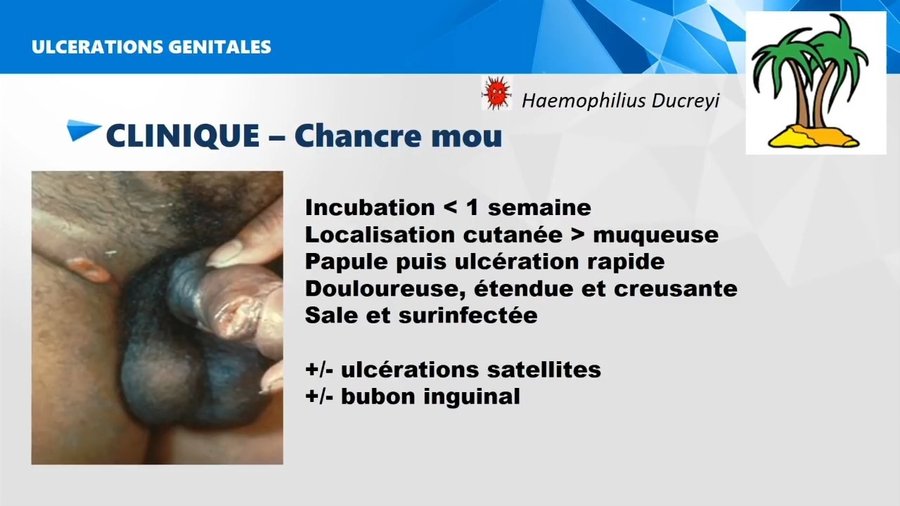 Chancre mou : ulcération creusante, sale et douloureuse