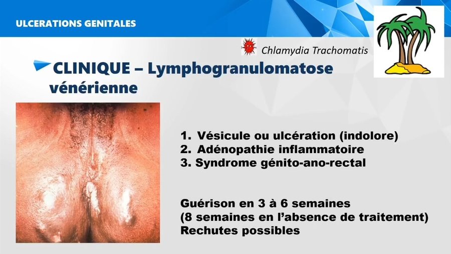 Lymphogranulomatose vénérienne : ulcération/vésicule génitale peu symptomatique