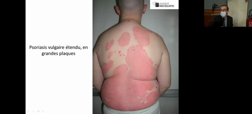 Psoriasis vulgaire étendu, en grandes plaques